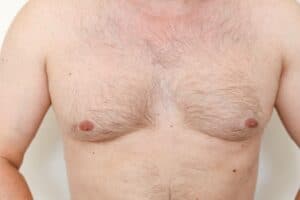 Gynecomastia Candidates Phoenix