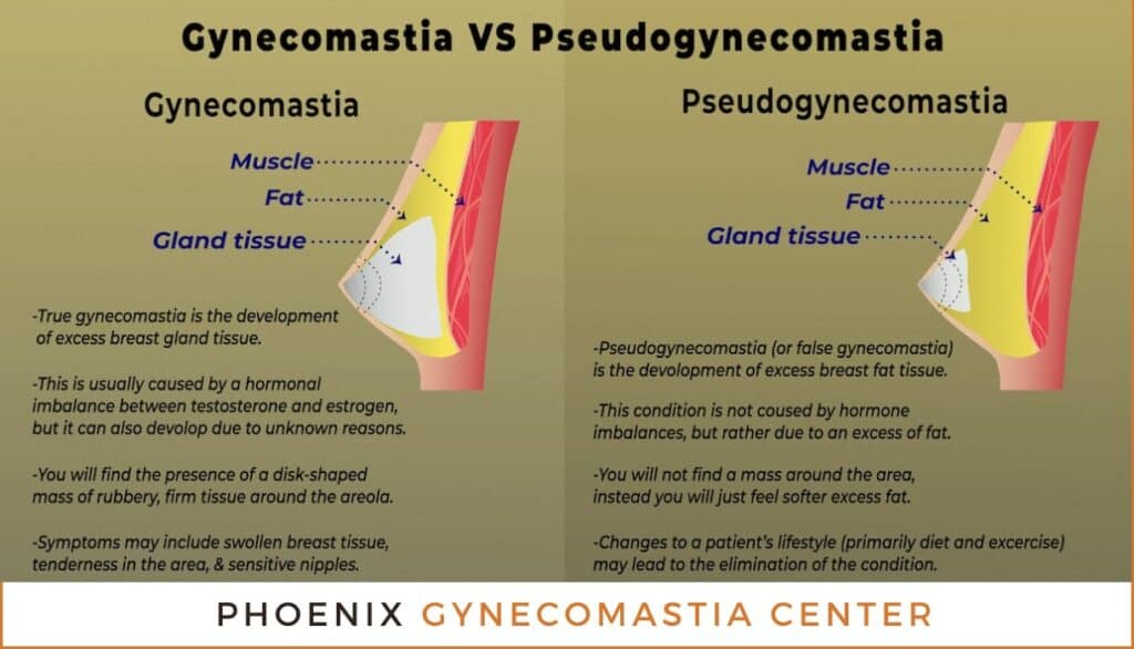 Gynecomastia vs. Pseudogynecomastia