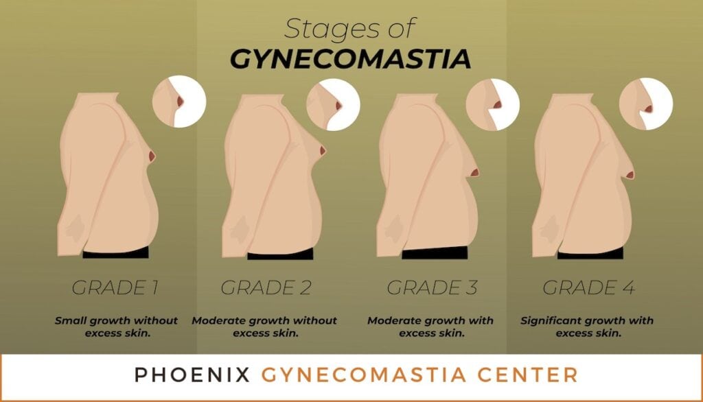 Stages and Grades of Gynecomastia Phoenix