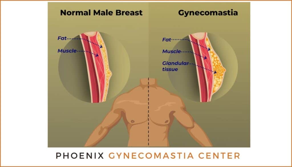 What is Gynecomastia Phoenix